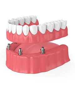 four dental implants supporting a full denture 