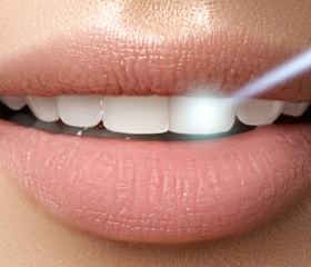 teeth whitening