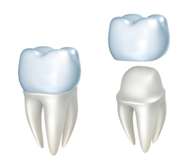 dental crowns