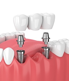 Dental implant bridge in Oshkosh