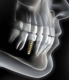 X-ray of a patient with a dental implant 