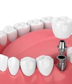 single dental implant supporting a crown 