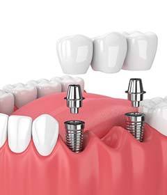 two dental implants supporting a bridge 