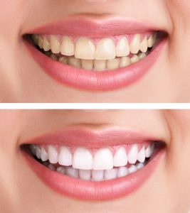 A smile before and after teeth whitening