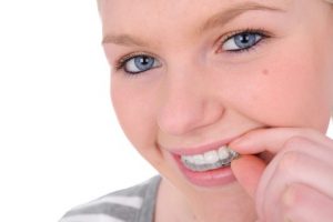 woman wearing Invisalign aligner