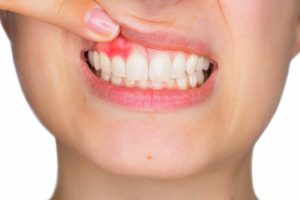 Woman showing her gums.