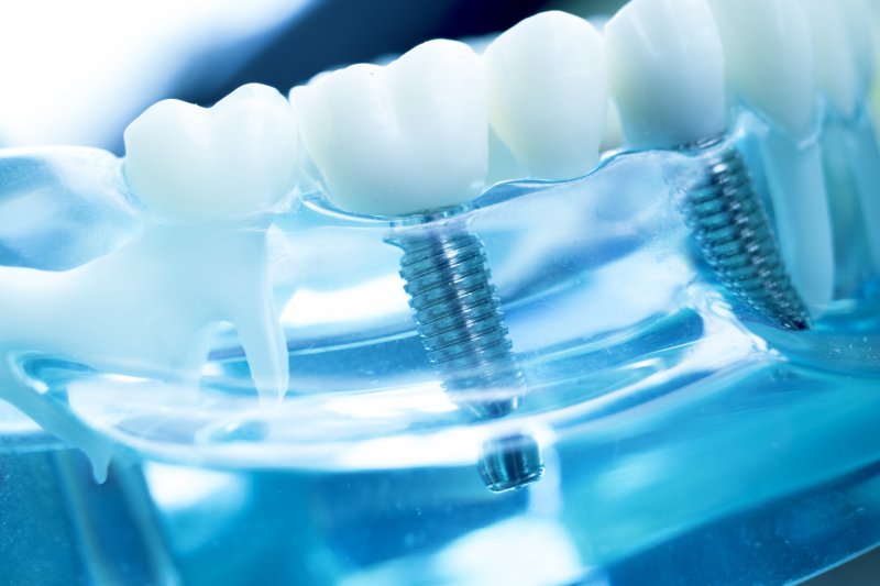 Model of dental implants in Freedom