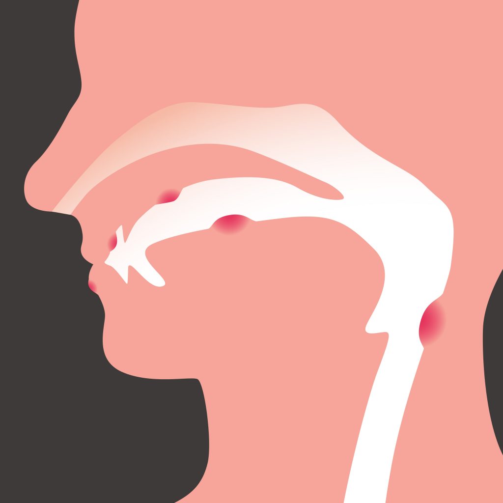 Oral disease illustration.